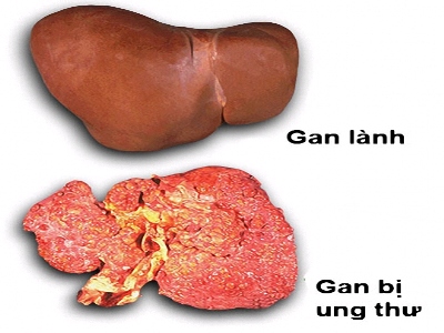 6 thảo dược giúp thải độc gan
