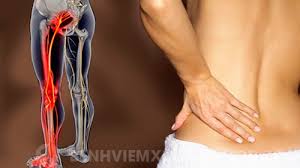 Bài thuốc chữa đau dây thần kinh hông