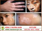 Những bài thuốc nam chữa bệnh bạch biến rất hiệu quả, nhiều người tin dùng